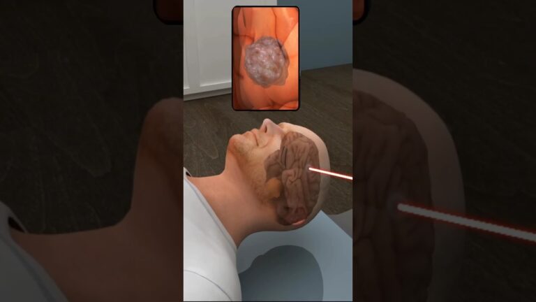 How To Brain Tumor Is Treated ( 3D Animation ) #shorts #shortvideo